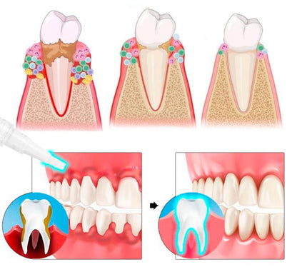 Gum Protect Gel！
