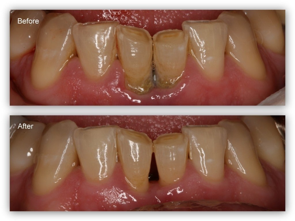 Gum Protect Gel！