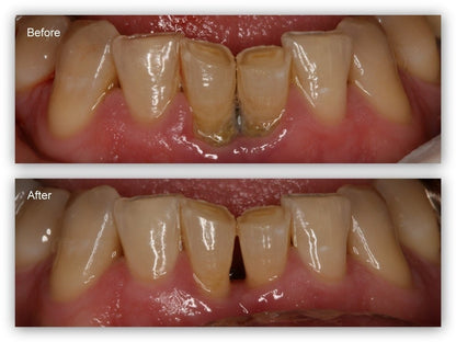 Gum Protect Gel！